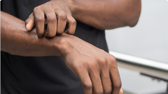 Man with skin irritation scratching his forearm.