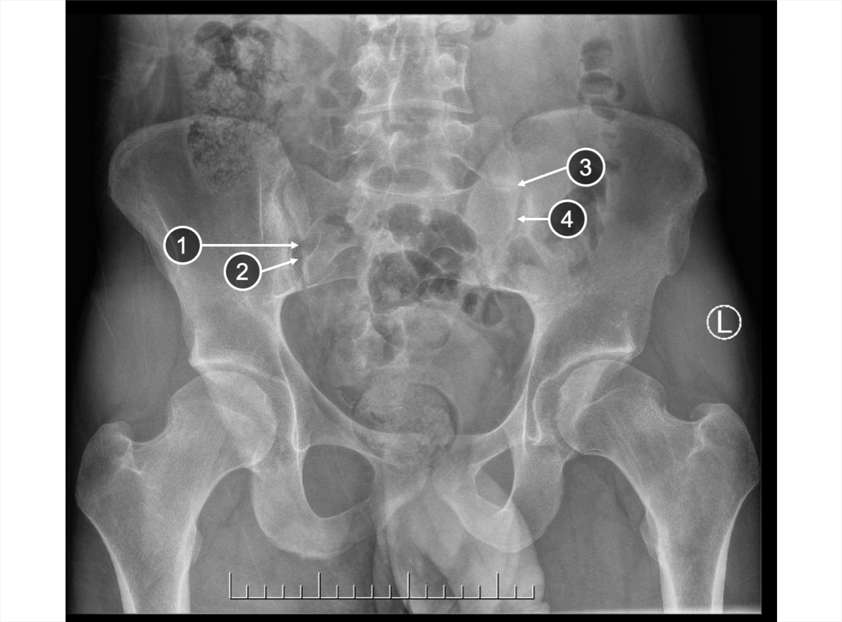 An X-ray of SIJ showing erosion and changes in joint space