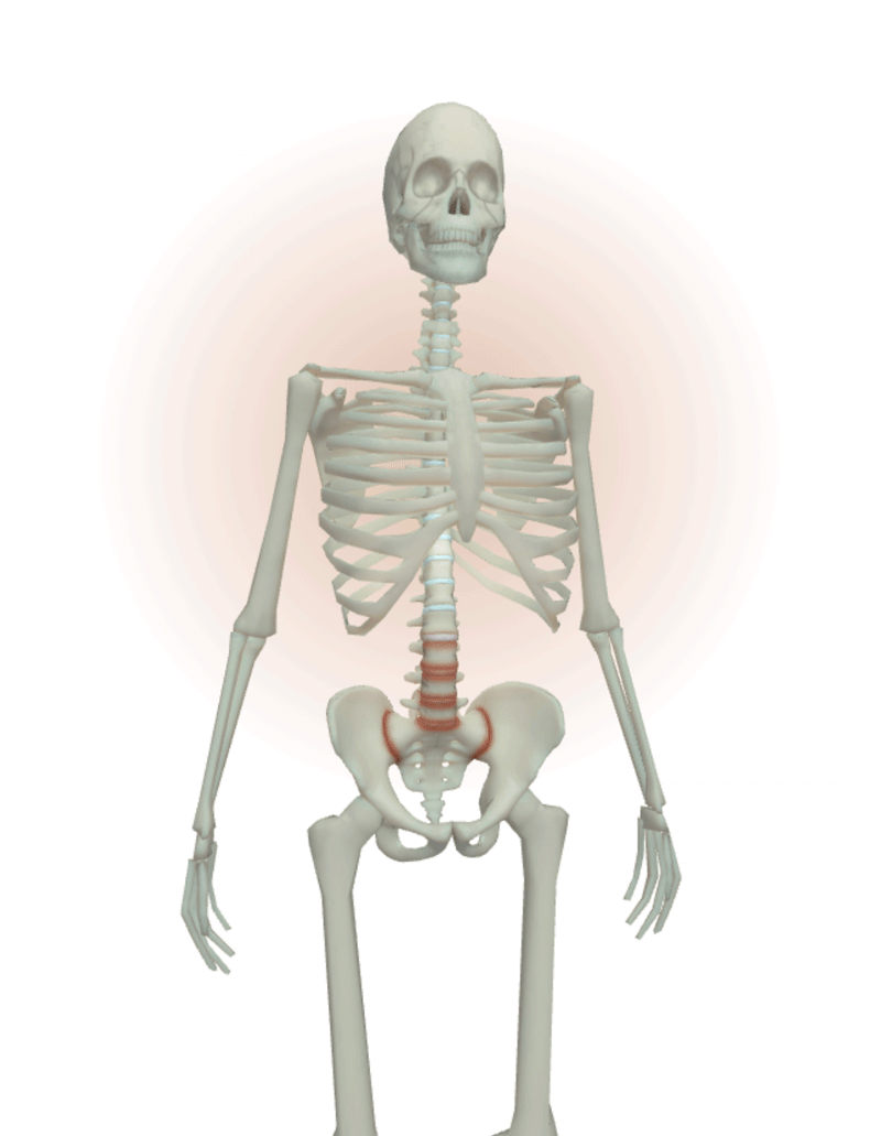 Early stage of inflammation and small areas of erosion in both SIJs and corner of vertebral bodies in the lumbar area (Reference 3)