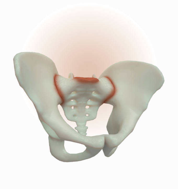 Inflammation and small areas of erosion in both SIJs (Reference 3)