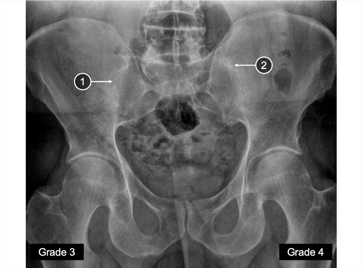 An X-ray of the SIJs showing different degree of fusion