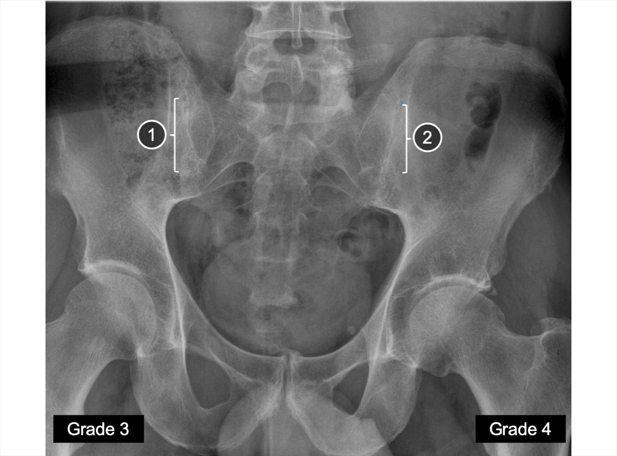 An X-ray of the SIJs showing different degree of fusion