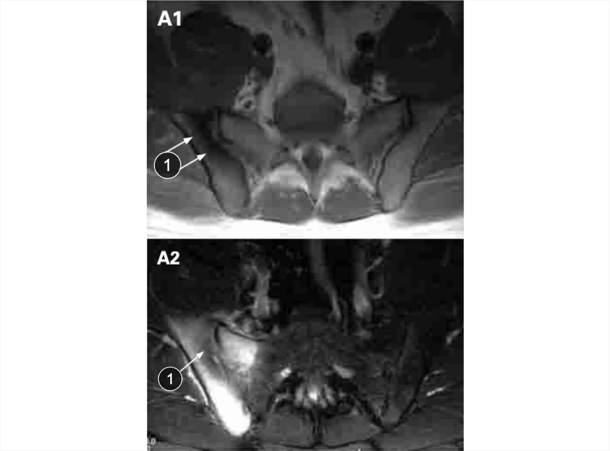 An MRI of the SIJs showing areas of sclerosis