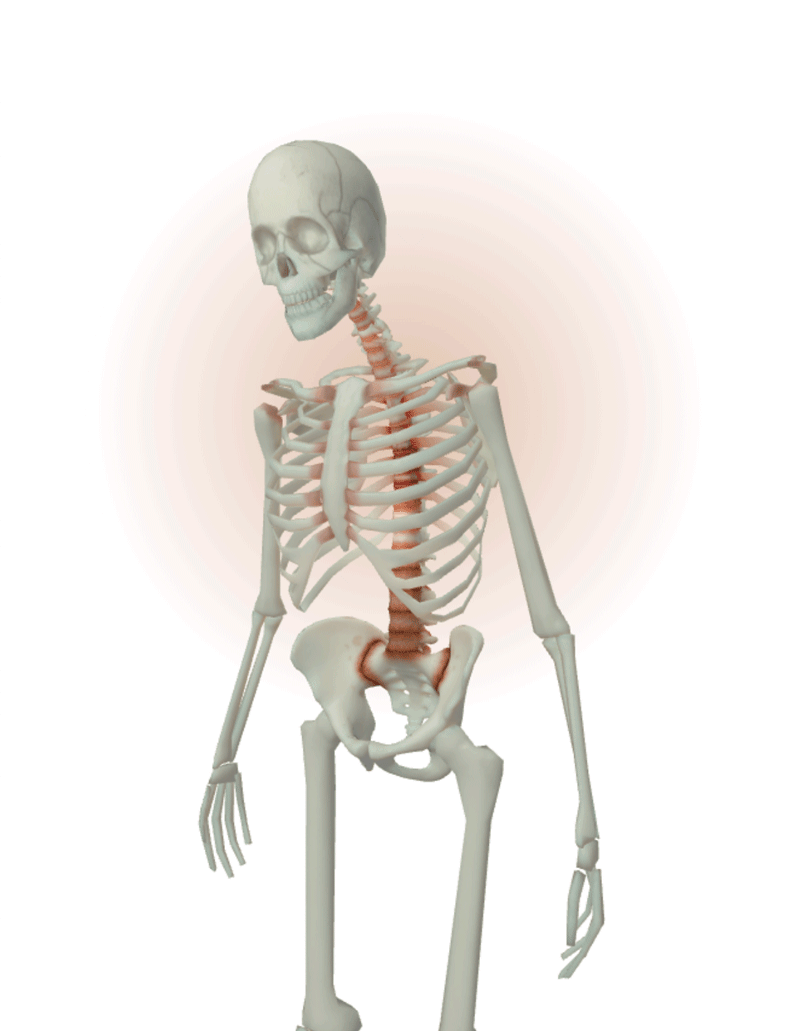 Inflammation is present, loss of joint space with ankylosing in SIJs, vertebrae affected along the spine with fused joints (Reference 11)