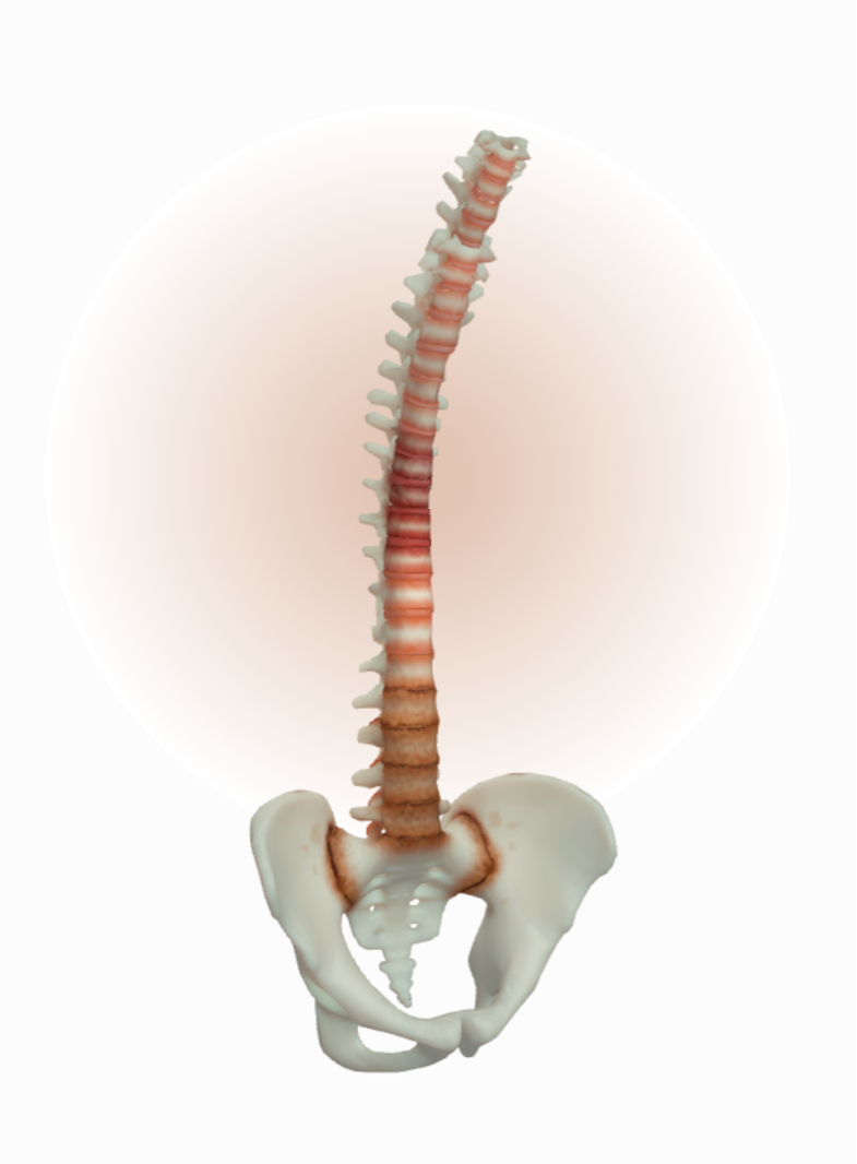 Late stage has inflammation, loss of joint space with ankylosing in SIJs, & fused joints in spine causing pathological change