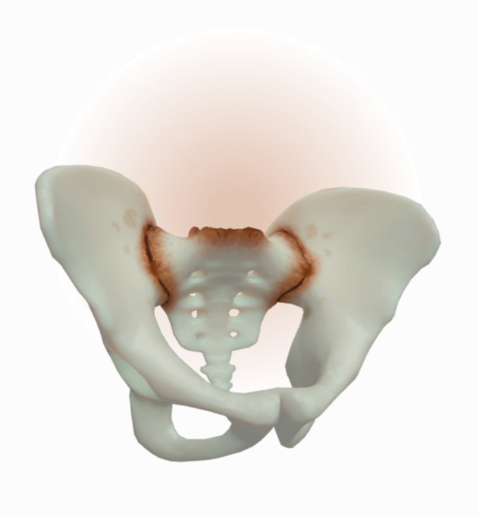 Inflammation is still present with loss of joint space and ankylosing in SIJs