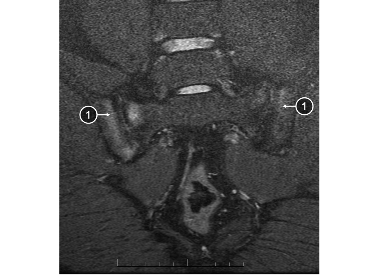 An MRI of SIJ showing bone marrow edema