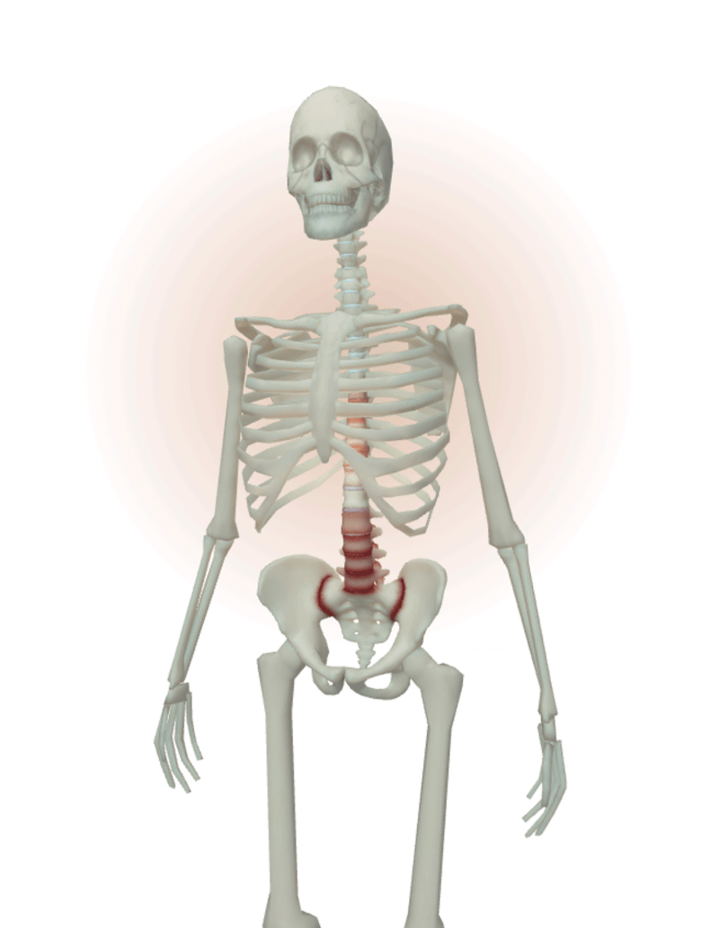 Inflammation, erosion, and some narrowing/widening of joint spaces on SIJs and spinal segments with syndesmophytes (Reference 11)