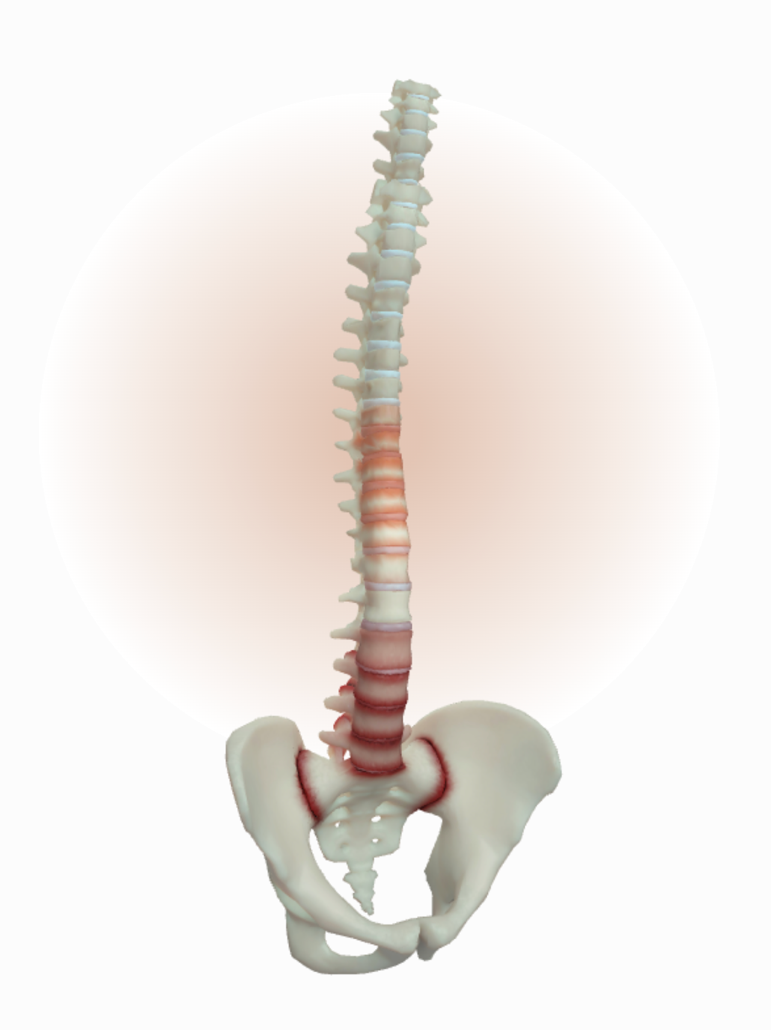 Mid stage has inflammation, erosion, syndesmophytes, some joint spaces changes on SIJs and spine causing pathological changes