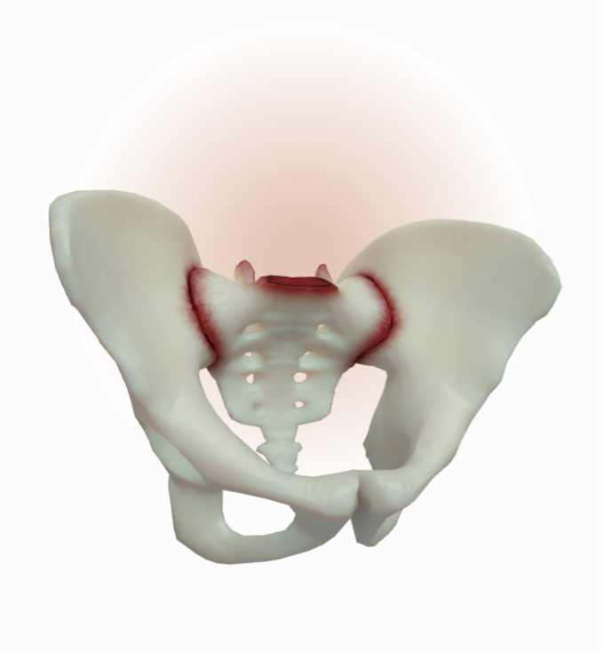 Inflammation, erosion, and some narrowing/widening of joint spaces on both sides of SIJ