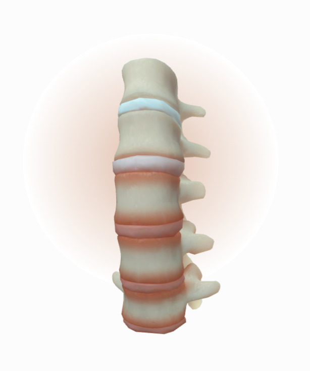 Inflammation in lumbar and thoracic spinal segments - with erosion, syndesmophytes, and bridging of joints (Reference 11)