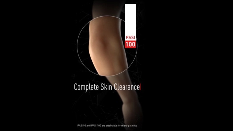 Complete Clearance in Psoriasis